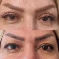 عمل(افتادگی پلک بالا و پایین )عمل زیبایی( گوش)|خدمات آرایشگری و زیبایی|فسا, |دیوار