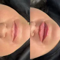 لیزر موهای زائد الکساندرایت۲۰۲۴ کوهرنت امریکا|خدمات آرایشگری و زیبایی|محمدشهر, محمدشهر|دیوار