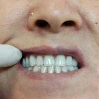 دندان مصنوعی|خدمات آرایشگری و زیبایی|کرج, کوی زنبق|دیوار