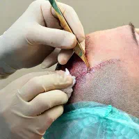 استخدام کادر درمان در کلینیک کاشت مو