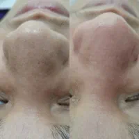 فیشیال تخصصی وپاکسازی پوست|خدمات آرایشگری و زیبایی|بندر کنگان, |دیوار