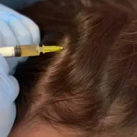فشیال پاکسازی پی آر پی هایفو لاغری کربن زگیل|خدمات زیبایی و سلامت|اصفهان, ملک‌شهر|دیوار