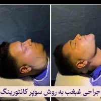 ساکشن غبغب و لیفتینگ به روش سوپرکانتورینگ(v line)