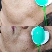 ریموو تتو و رفع تیرگی بدن در مطب پزشک