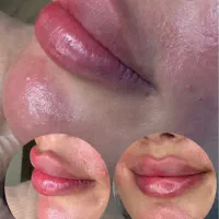 جشنواره تزریق چربی و فیلر به مناسبت روز دختر|خدمات آرایشگری و زیبایی|مریوان, |دیوار