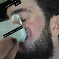 هایفوتراپی و آر اف|خدمات آرایشگری و زیبایی|قم, دورشهر|دیوار