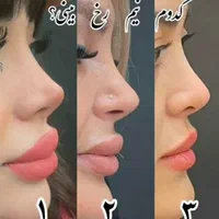 جراحی بینی  لیپوماتیک  پروتز سینه ابدو مامو لیفت|خدمات آرایشگری و زیبایی|اصفهان, مرداویج|دیوار