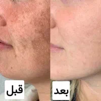 کرم ضد لک گیاهی وی ای پی|آرایشی، بهداشتی، درمانی|ایلام, |دیوار