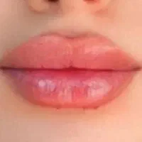 مدل تزریق ژل و بوتاکس