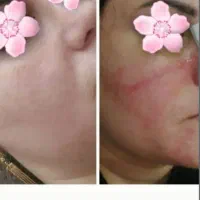 فشیال و پاکسازی سنتی|خدمات آرایشگری و زیبایی|سهند, |دیوار