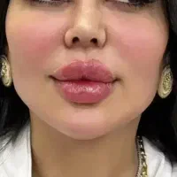 ژل فیلر ومزوتراپی پیرسینگ آفر ۵۰درصد