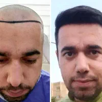 کاشت مو|خدمات آرایشگری و زیبایی|شیراز, زرگری|دیوار
