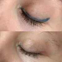 مدل فوری ریموو تتوی قدیمی وبدرنگ