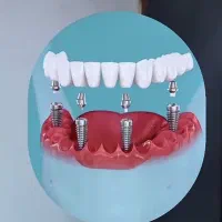 ایمپلنت کره ای با روکش ۱۸۹۰۰ اقساط ۱۲ ماهه