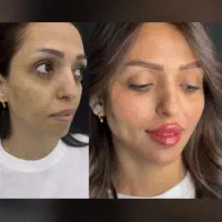 تزریقات ژل شروع قیمت از 750