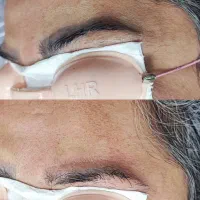 ریموو تتو و رفع تیرگی بدن در مطب پزشک|خدمات آرایشگری و زیبایی|آبادان, |دیوار