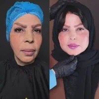 تزریقات فیلر و بوتاکس و انواع مزوها  توسط پزشک