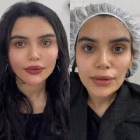تخفیف ویژه تزریق چربی صورت/فیلربادی/بوکالفت/غبغب