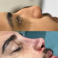 آف محدودجراحی بینی دراهوازفق۲۵ت