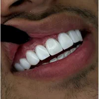 دندانپزشکی کامپوزیت روکش‌ لمینت عصب کشی ترمیم