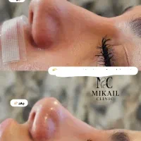 بمب تخفیف ژل بوتاکس فیلر فقط ۱۲۰۰ فقط یک هفته