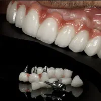 شرایط ویژه جشنواره دندانپزشکی ایمپلنت اوردنچر روکش