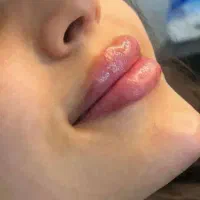 ژل لب و کل صورت