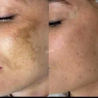 برداشتن خال،پرسینگ،چال گونه،میکرودرمال،کرم پودر|خدمات آرایشگری و زیبایی|کرمانشاه, |دیوار