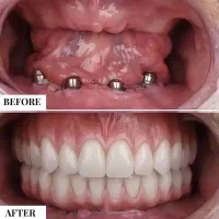 جشنواره دندانپزشکی ، ایمپلنت فقط ۱۰/۳۰۰|خدمات آرایشگری و زیبایی|تبریز, |دیوار