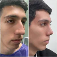 عمل زیبای  بینی بدونه بیهوشی