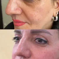 مطب تزریق فیلر(ژل)لب بادی کانتور چانه لیفت بوتاکس|خدمات زیبایی و سلامت|تهران, امامت|دیوار