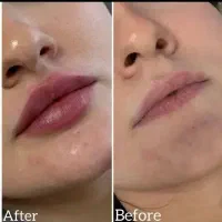 فشیال پاکسازی پی آر پی هایفو لاغری کربن زگیل|خدمات زیبایی و سلامت|اصفهان, ملک‌شهر|دیوار