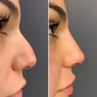 تزریق ژل لب و بوتاکس|خدمات آرایشگری و زیبایی|تهران, خزانه|دیوار