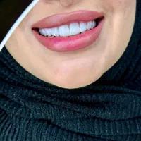 جشنواره کامپوزیت لمینیت عصب IPS IMAX روکش N2 ونیر