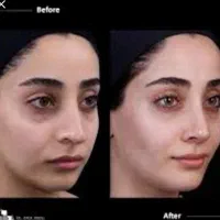 جراحی بینی.صورت.لیفت.پیکرتراشی|خدمات آرایشگری و زیبایی|کرج, گلشهر|دیوار
