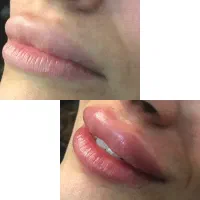 ژل وبوتاکس