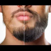 درمان طبیعی رویش تکه ای ریش و رویش کامل