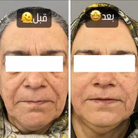 هایفوتراپی|خدمات آرایشگری و زیبایی|اصفهان, هزارجریب|دیوار
