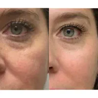 لاغری با طب سوزنی تخصصی