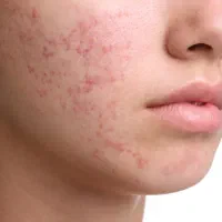 درمان گیاهی جوش صورت