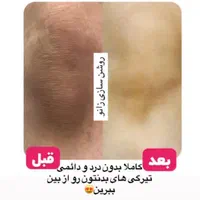 تخفیف لیزر اشنایدرپلاس و روشن سازی نواحی تیره|خدمات آرایشگری و زیبایی|بندرعباس, |دیوار