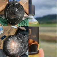 سرم بیوپلاس رفع ریزش و رویش مجدد فرانسوی نمایندگی