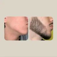 خداحافظی با ریش و مو کم‌پشت تو کمتر از ۴۵ روز