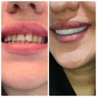 کامپوزیت دندان|خدمات آرایشگری و زیبایی|کوهدشت, |دیوار