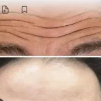 انجام تمام خدمات فیلر|خدمات آرایشگری و زیبایی|شهرکرد, |دیوار