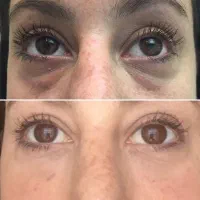 جشنواره ژل ،بوتاکس ،جوانساز .پروفایلو،فیلر لب