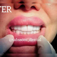 کامپوزیت ونیر و زیبایی/تخفیف ویژه فقط تا روز پدر