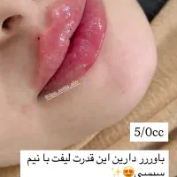 ژل وبوتاکس|خدمات آرایشگری و زیبایی|اهواز, کمپلو شمالی|دیوار