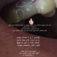 ساخت دندان محکم دائمی در خانه