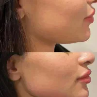 جشنواره تزریق ژل و بوتاکس زیر نظر پزشک